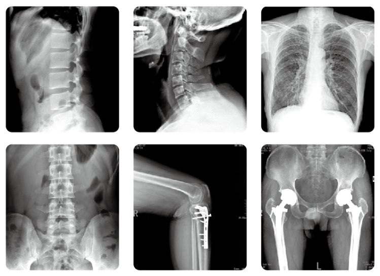 LX8500C鐮刀臂dr臨床影像 LX8500C鐮刀臂dr臨床影像