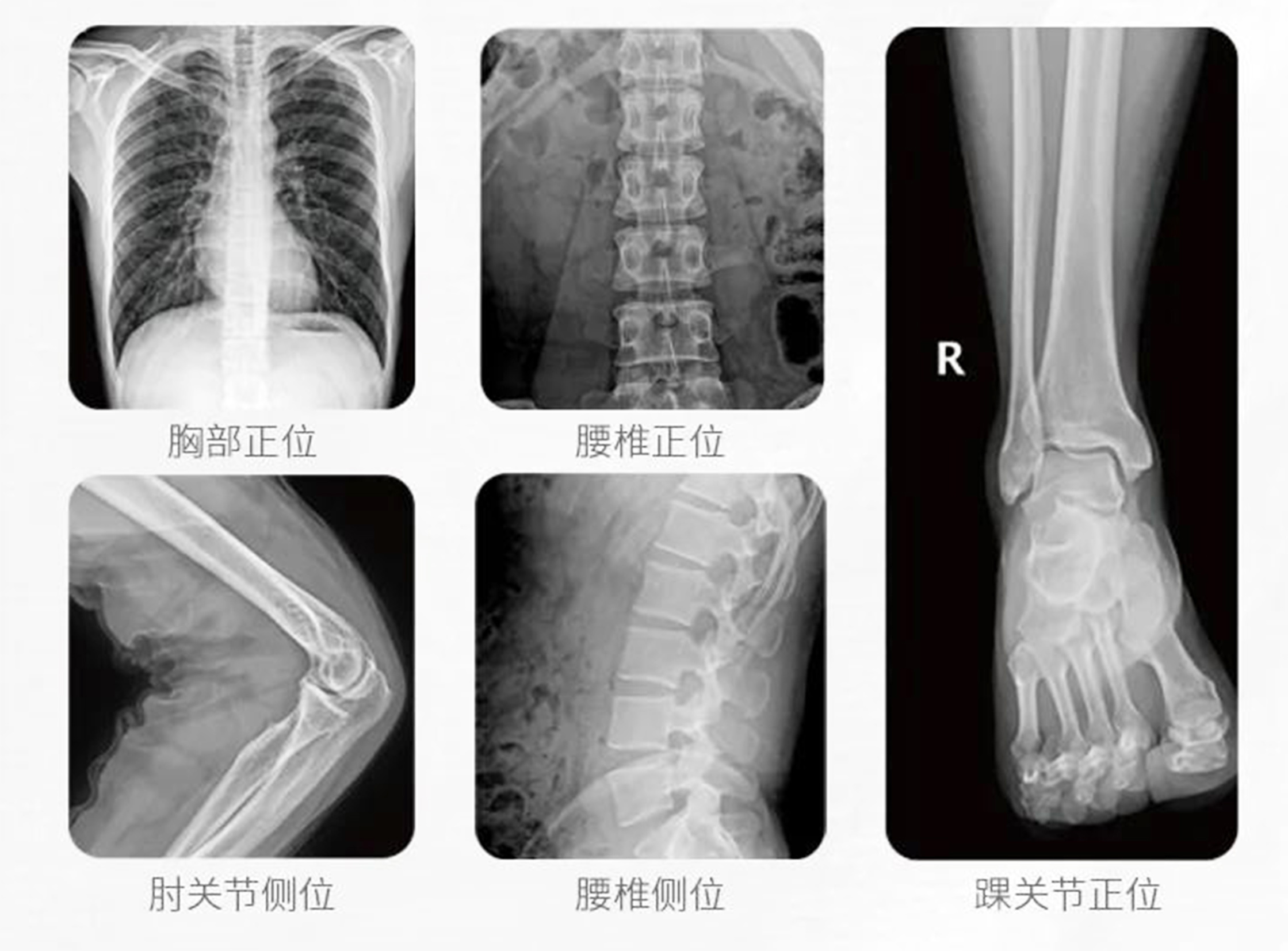 移動式DR臨床影像 移動式DR臨床影像