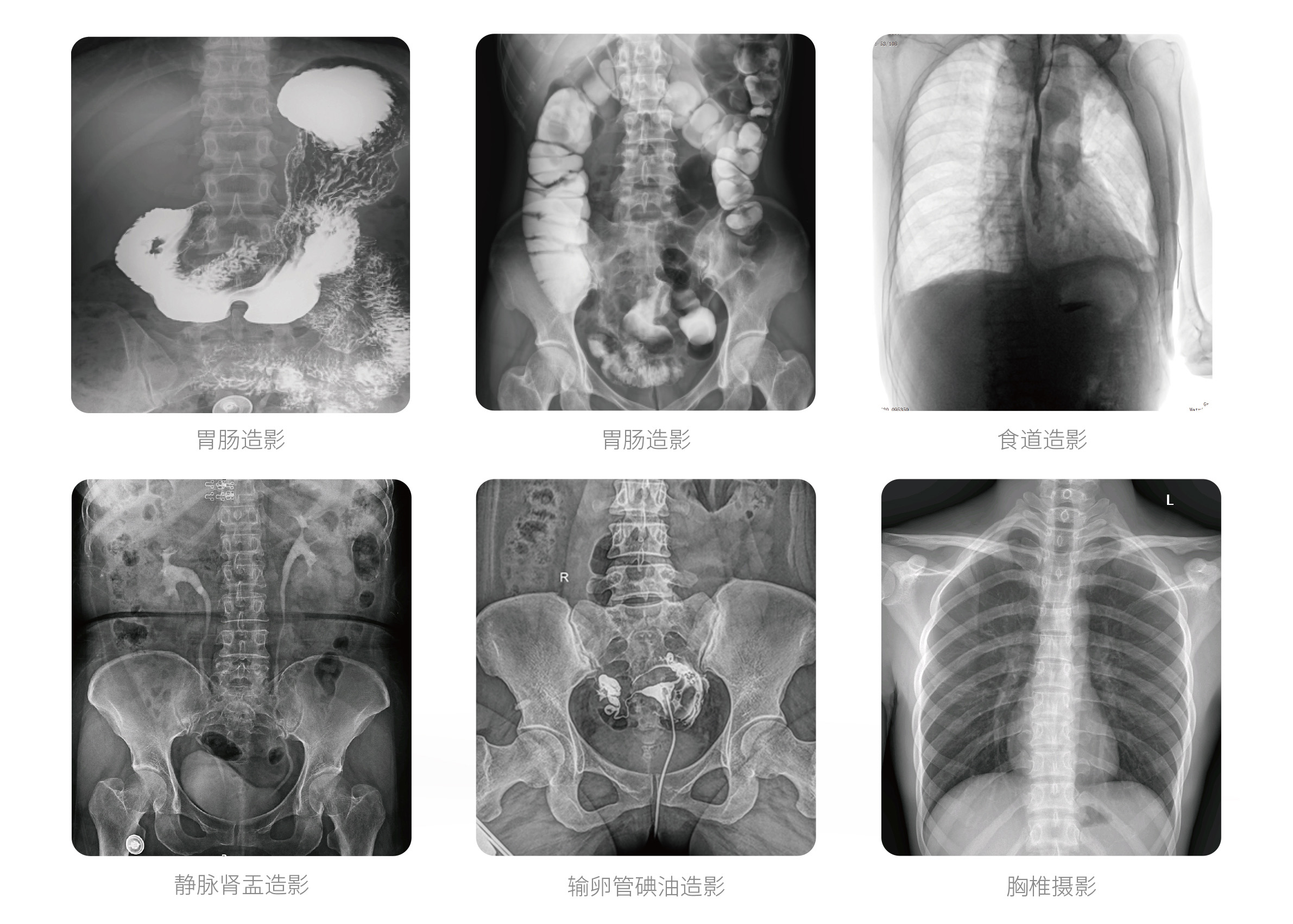 PLX8500E動態U臂DR臨床影像 PLX8500E動態U臂DR臨床影像